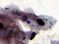 Chlamydia pneumoniae в эпителиальных клетках уретры при интерстициальном цистите.
